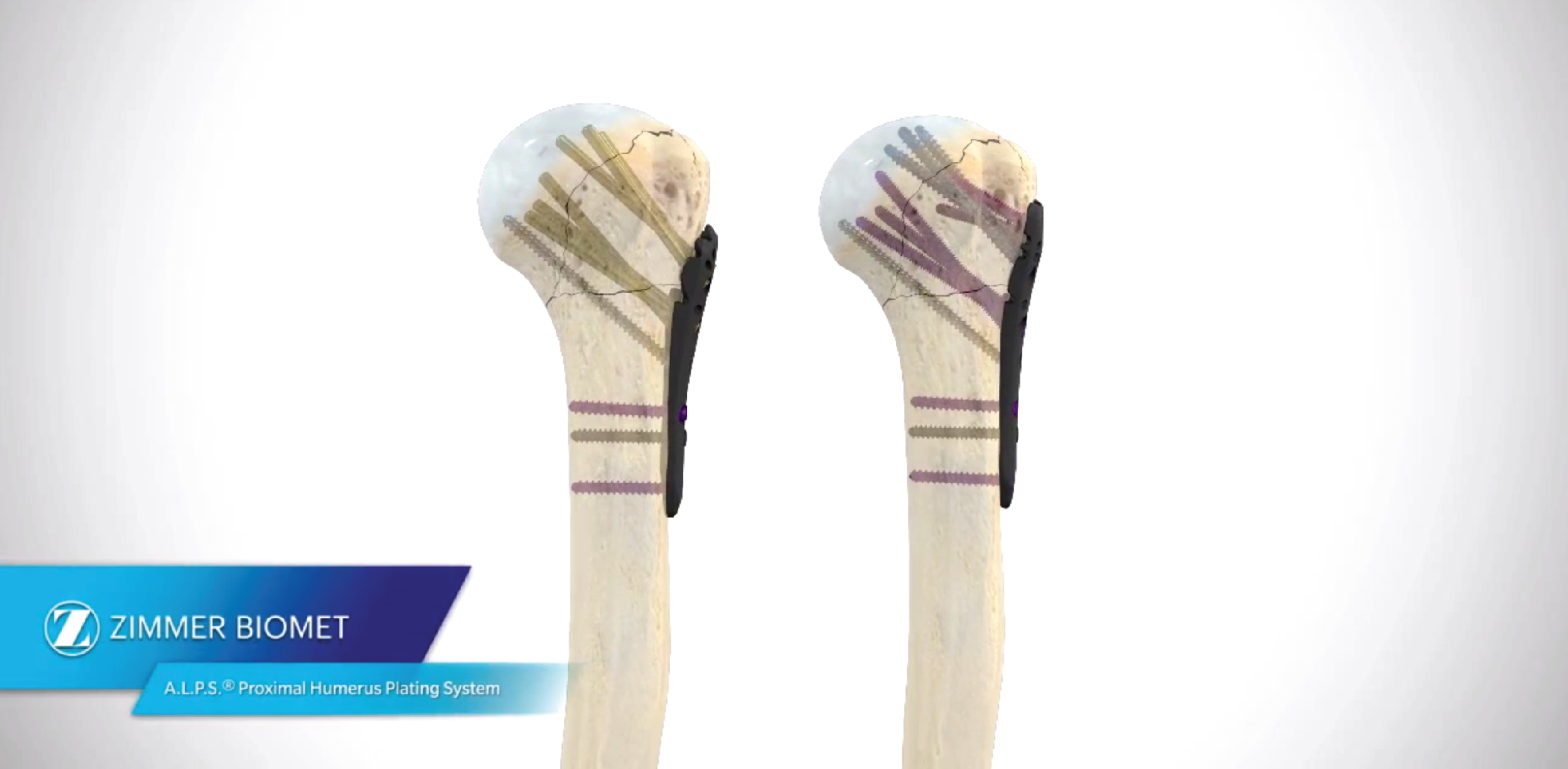 A.L.P.S Proximal Humerus Plating System