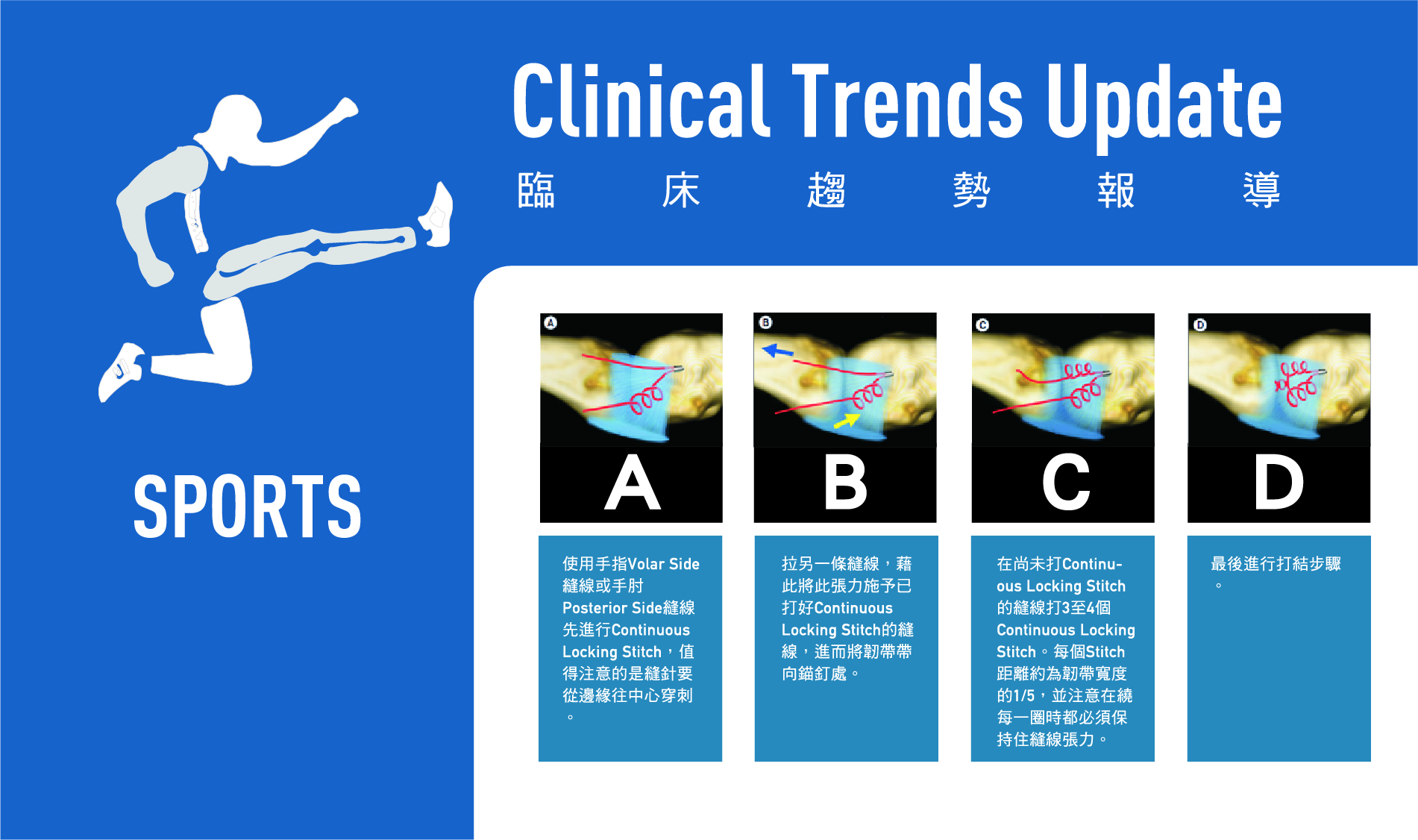 副韌帶修補如何達到一勞永逸？最新手法大公開！
