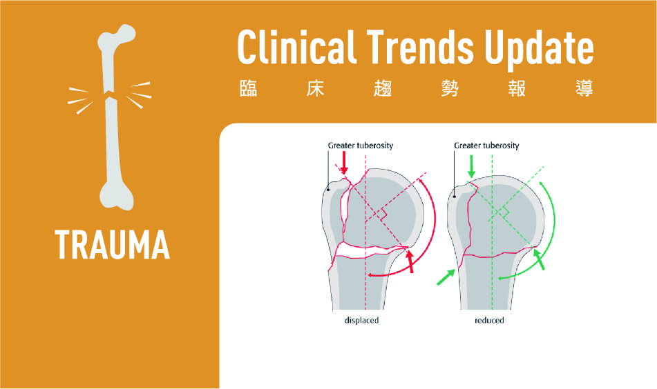 Proximal Humerus Fracture: Overview