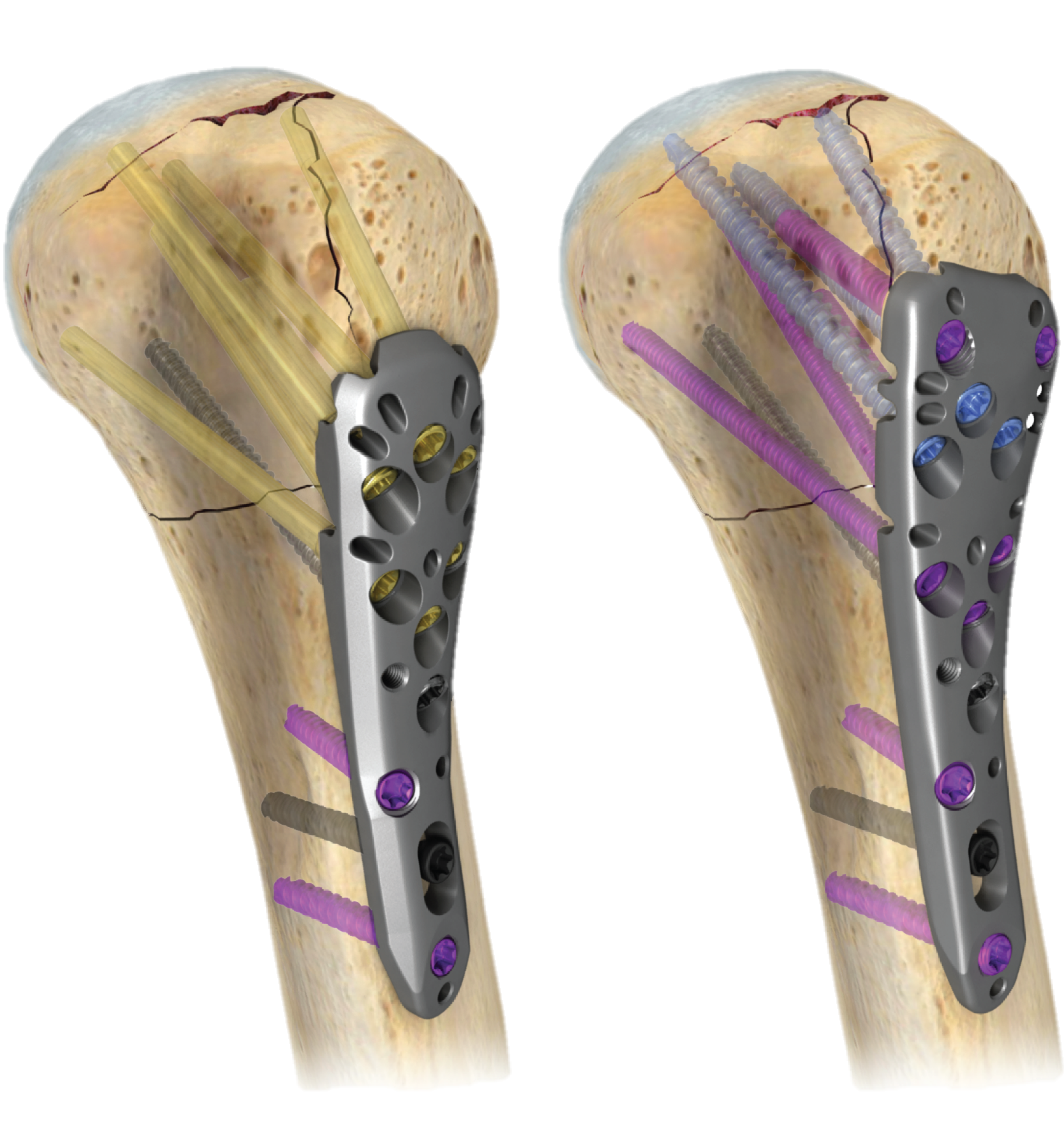 A.L.P.S.® PROXIMAL HUMERUS PLATING SYSTEM