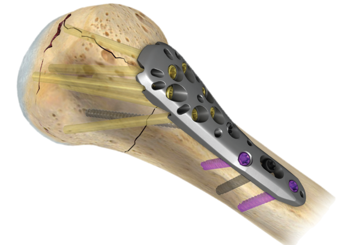 A.L.P.S.® PROXIMAL HUMERUS PLATING SYSTEM