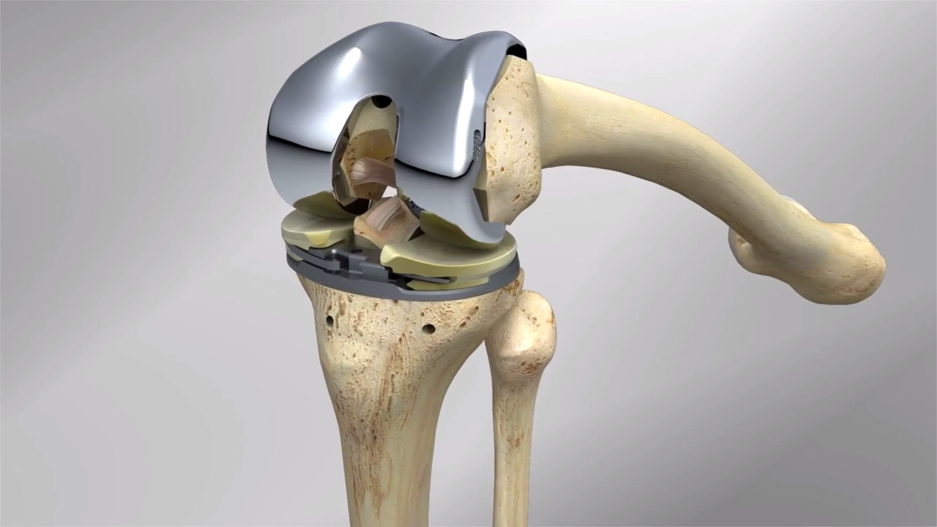 Vanguard Surgical Technique
